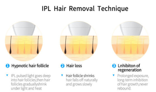 2000w OPT IPL+ 808NM LASERA DIODOWEGO do urządzeń do usuwania włosów
